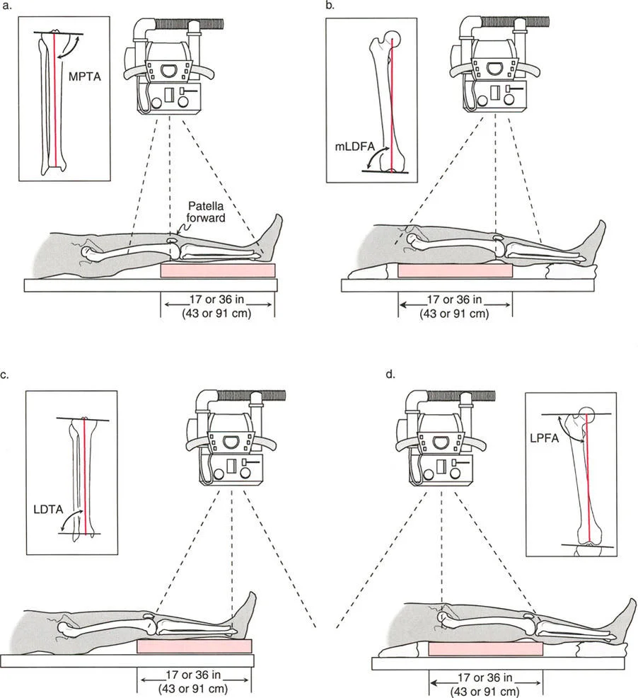صورة طبية: اختلال محاذاة وتشوهات الأطراف السفلية في المستوى الأمامي: دليل شامل من الأستاذ الدكتور محمد هطيف