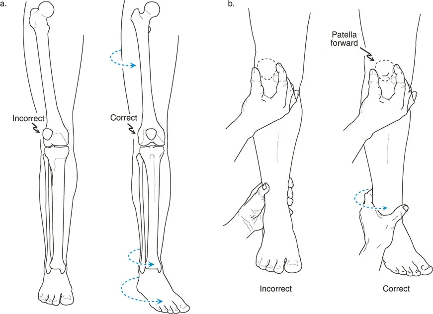 صورة طبية: اختلال محاذاة وتشوهات الأطراف السفلية في المستوى الأمامي: دليل شامل من الأستاذ الدكتور محمد هطيف