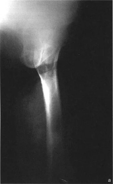 صورة طبية: اختلال محاذاة وتشوهات الأطراف السفلية في المستوى الأمامي: دليل شامل من الأستاذ الدكتور محمد هطيف