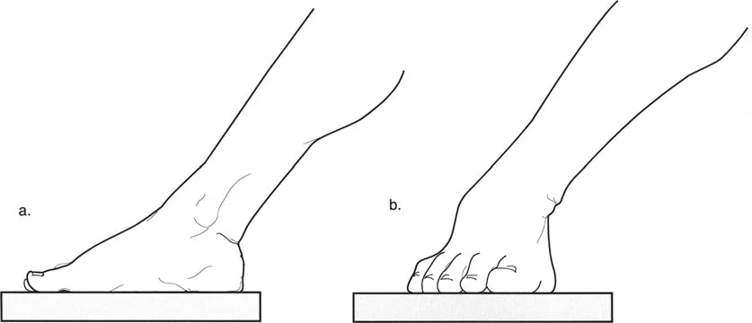 صورة طبية: اختلال محاذاة وتشوهات الأطراف السفلية في المستوى الأمامي: دليل شامل من الأستاذ الدكتور محمد هطيف