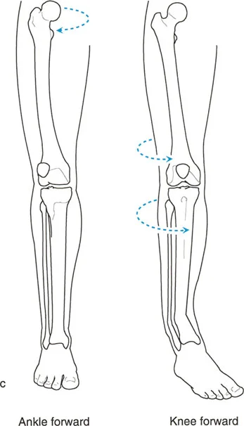 صورة طبية: اختلال محاذاة وتشوهات الأطراف السفلية في المستوى الأمامي: دليل شامل من الأستاذ الدكتور محمد هطيف