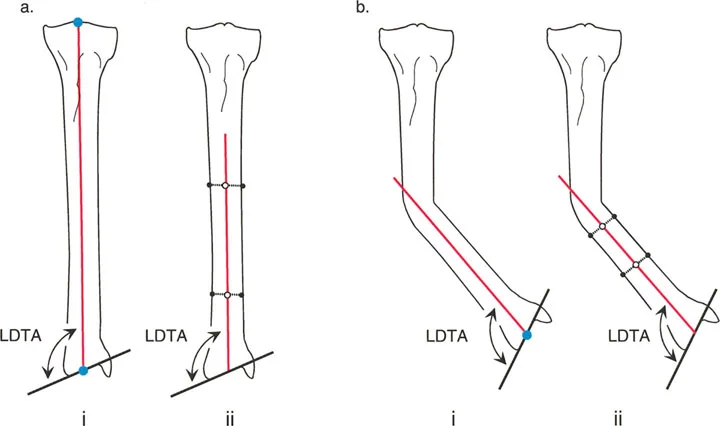 صورة طبية: اختلال محاذاة وتشوهات الأطراف السفلية في المستوى الأمامي: دليل شامل من الأستاذ الدكتور محمد هطيف