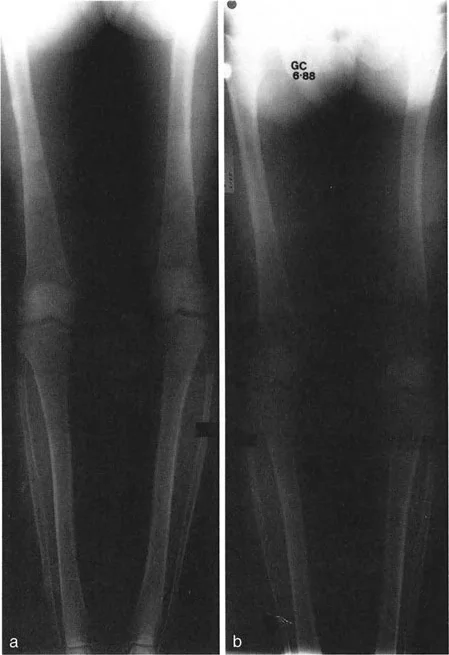 صورة طبية: اختلال محاذاة وتشوهات الأطراف السفلية في المستوى الأمامي: دليل شامل من الأستاذ الدكتور محمد هطيف