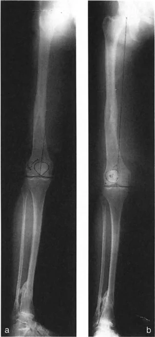 صورة طبية: اختلال محاذاة وتشوهات الأطراف السفلية في المستوى الأمامي: دليل شامل من الأستاذ الدكتور محمد هطيف