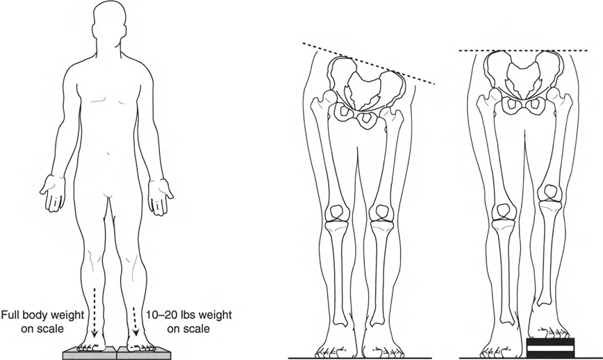 صورة طبية: اختلال محاذاة وتشوهات الأطراف السفلية في المستوى الأمامي: دليل شامل من الأستاذ الدكتور محمد هطيف