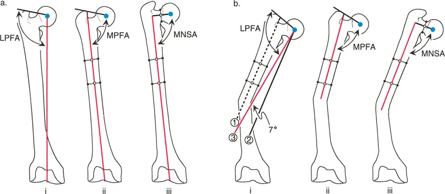 صورة طبية: اختلال محاذاة وتشوهات الأطراف السفلية في المستوى الأمامي: دليل شامل من الأستاذ الدكتور محمد هطيف