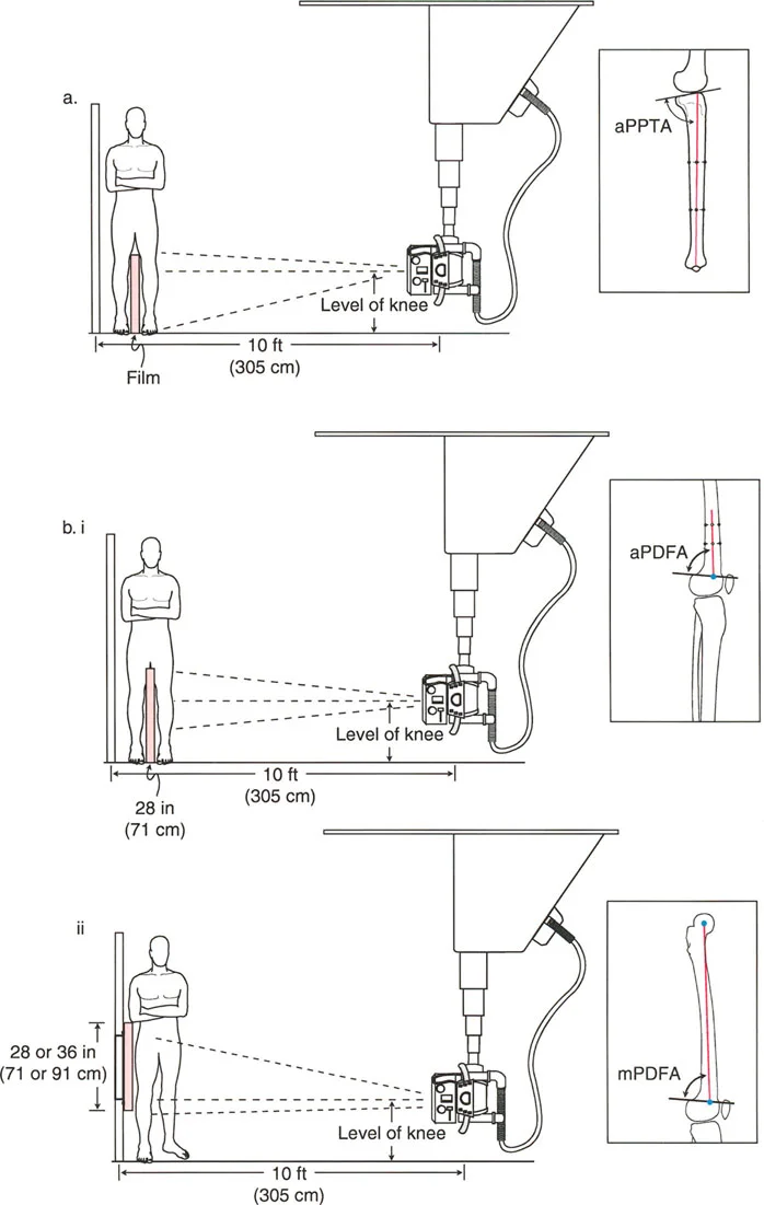 صورة طبية: اختلال محاذاة وتشوهات الأطراف السفلية في المستوى الأمامي: دليل شامل من الأستاذ الدكتور محمد هطيف