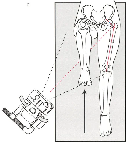 صورة طبية: اختلال محاذاة وتشوهات الأطراف السفلية في المستوى الأمامي: دليل شامل من الأستاذ الدكتور محمد هطيف