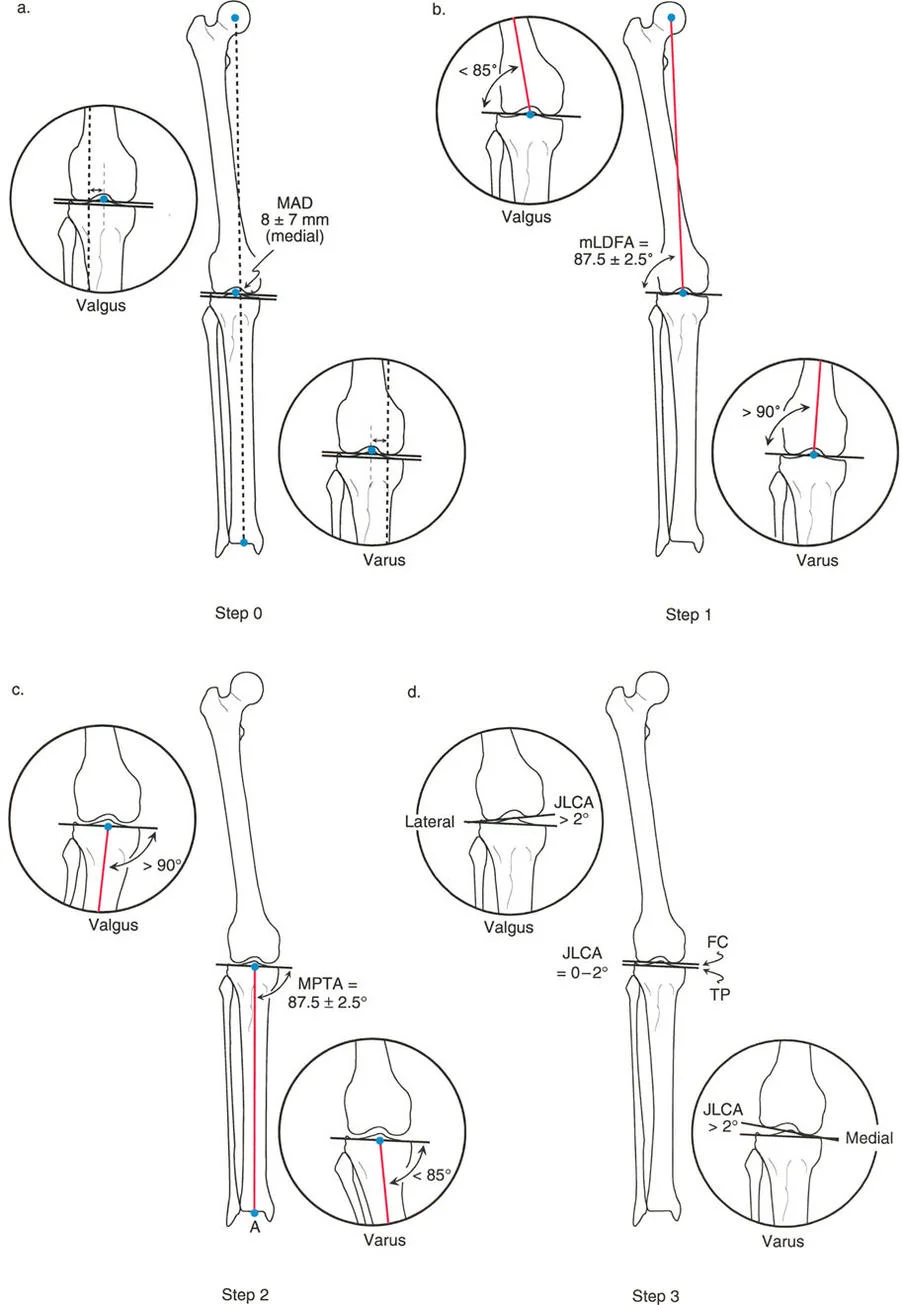 صورة توضيحية لـ اختلال محاذاة وتشوهات الأطراف السفلية في المستوى الأمامي: دليل شامل من الأستاذ الدكتور محمد هطيف