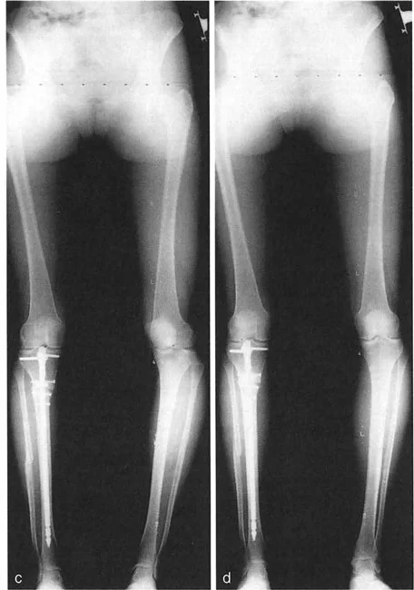 صورة طبية: اختلال محاذاة وتشوهات الأطراف السفلية في المستوى الأمامي: دليل شامل من الأستاذ الدكتور محمد هطيف