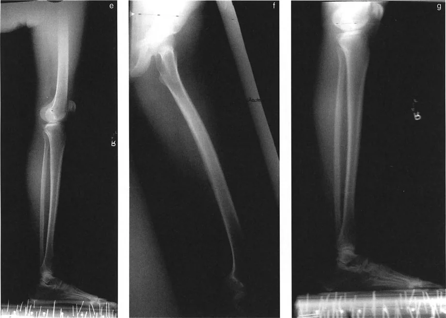صورة طبية: اختلال محاذاة وتشوهات الأطراف السفلية في المستوى الأمامي: دليل شامل من الأستاذ الدكتور محمد هطيف