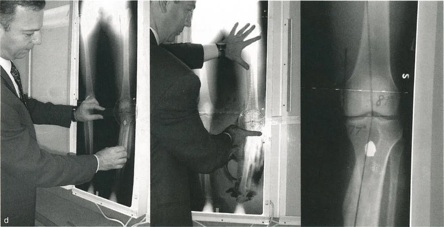 صورة توضيحية لـ اختلال محاذاة وتشوهات الأطراف السفلية في المستوى الأمامي: دليل شامل من الأستاذ الدكتور محمد هطيف