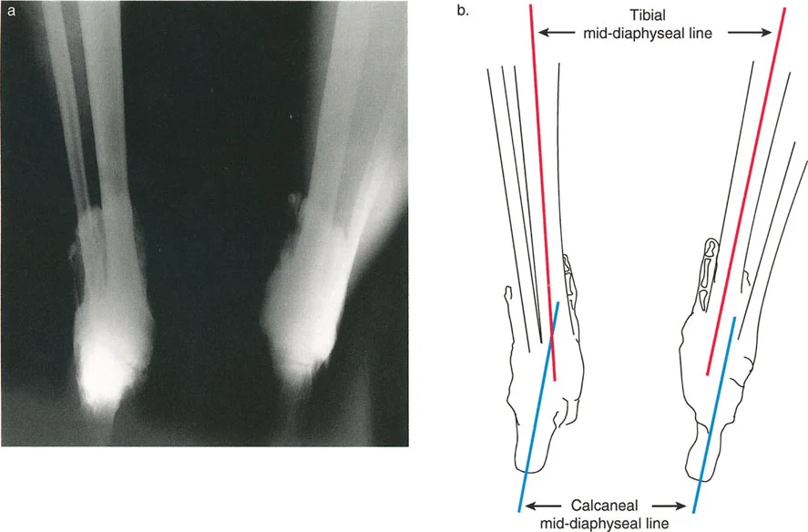 صورة طبية: اختلال محاذاة وتشوهات الأطراف السفلية في المستوى الأمامي: دليل شامل من الأستاذ الدكتور محمد هطيف