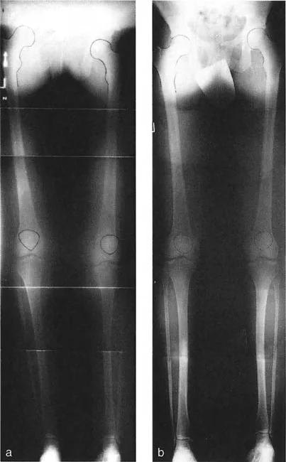 صورة طبية: اختلال محاذاة وتشوهات الأطراف السفلية في المستوى الأمامي: دليل شامل من الأستاذ الدكتور محمد هطيف