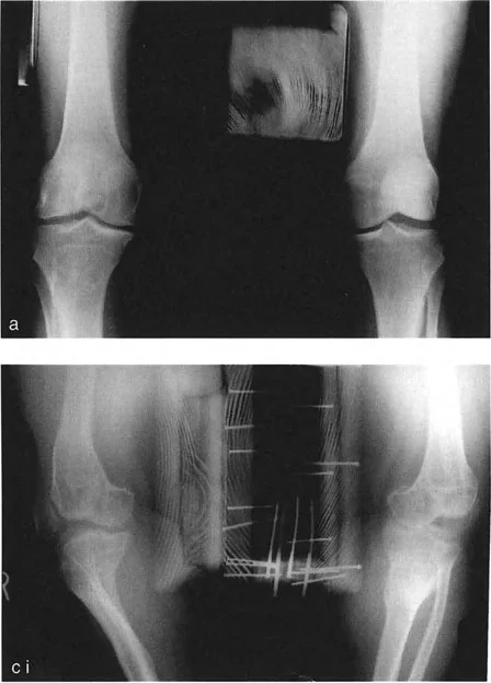صورة طبية: اختلال محاذاة وتشوهات الأطراف السفلية في المستوى الأمامي: دليل شامل من الأستاذ الدكتور محمد هطيف