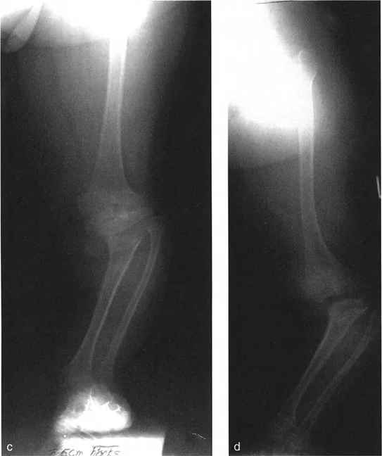 صورة طبية: اختلال محاذاة وتشوهات الأطراف السفلية في المستوى الأمامي: دليل شامل من الأستاذ الدكتور محمد هطيف