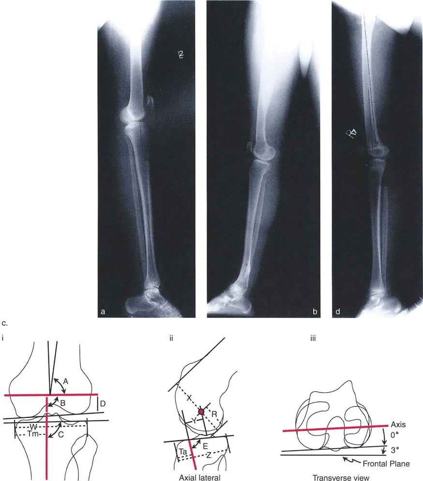 صورة طبية: اختلال محاذاة وتشوهات الأطراف السفلية في المستوى الأمامي: دليل شامل من الأستاذ الدكتور محمد هطيف