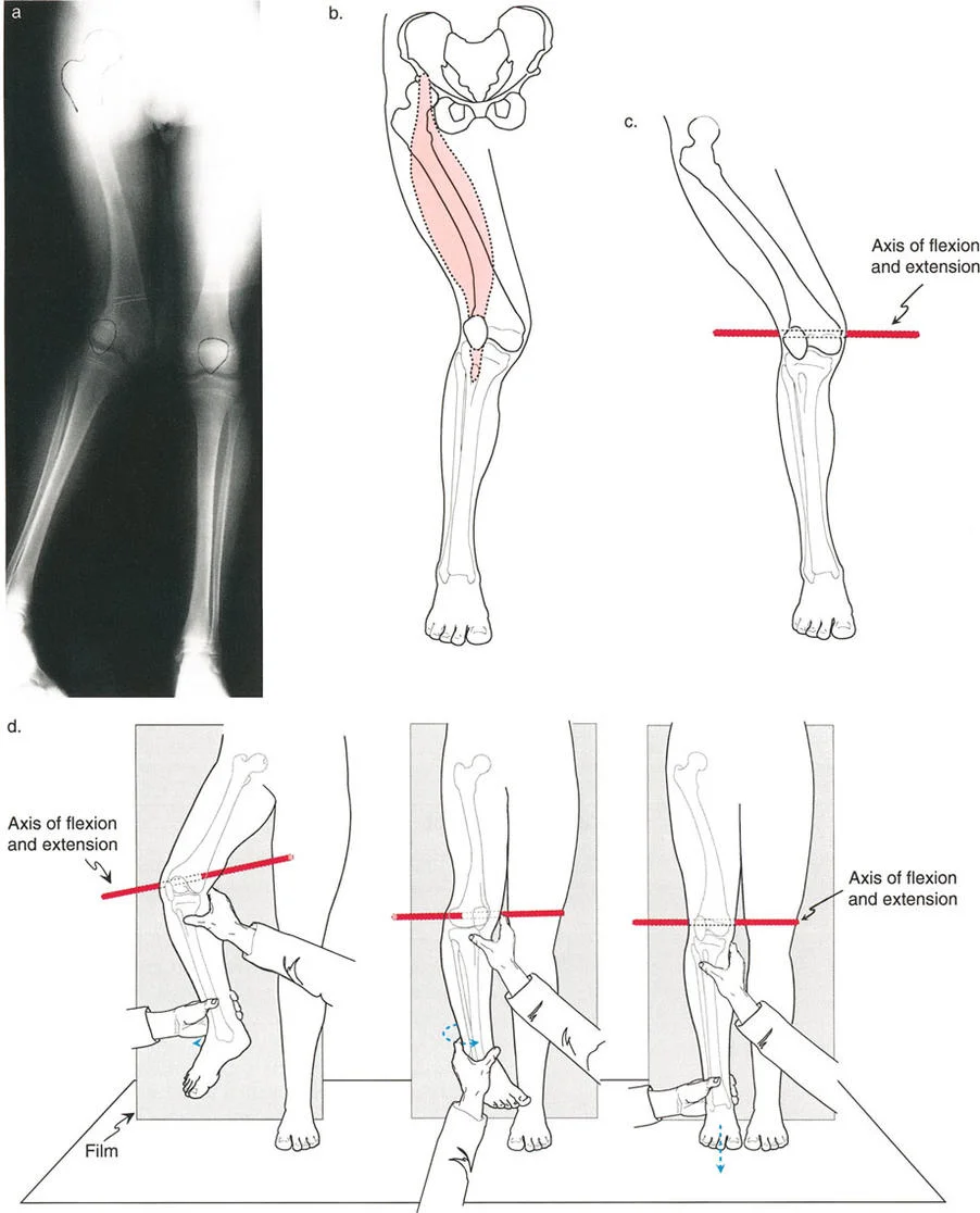 صورة طبية: اختلال محاذاة وتشوهات الأطراف السفلية في المستوى الأمامي: دليل شامل من الأستاذ الدكتور محمد هطيف