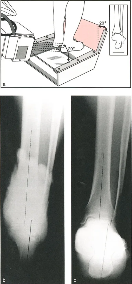 صورة طبية: اختلال محاذاة وتشوهات الأطراف السفلية في المستوى الأمامي: دليل شامل من الأستاذ الدكتور محمد هطيف