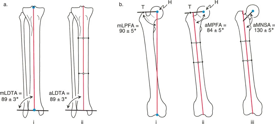 صورة طبية: اختلال محاذاة وتشوهات الأطراف السفلية في المستوى الأمامي: دليل شامل من الأستاذ الدكتور محمد هطيف