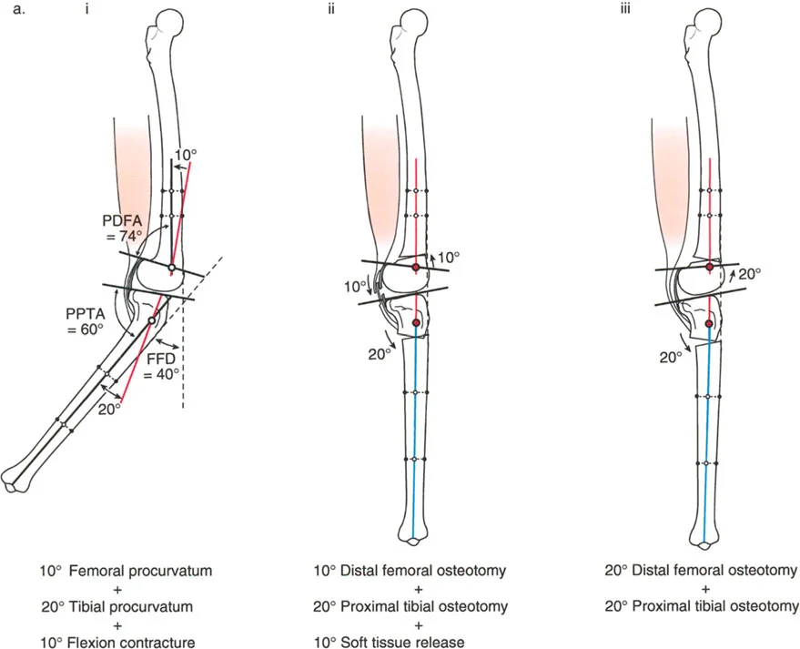 صورة طبية: جراحة إعادة تنظيم الركبة: حل متقدم لخشونة المفصل أحادي الحجرة وتشوهات الركبة