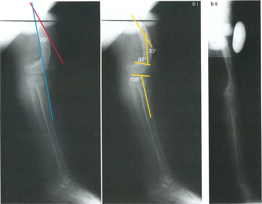 صورة طبية: جراحة إعادة تنظيم الركبة: حل متقدم لخشونة المفصل أحادي الحجرة وتشوهات الركبة