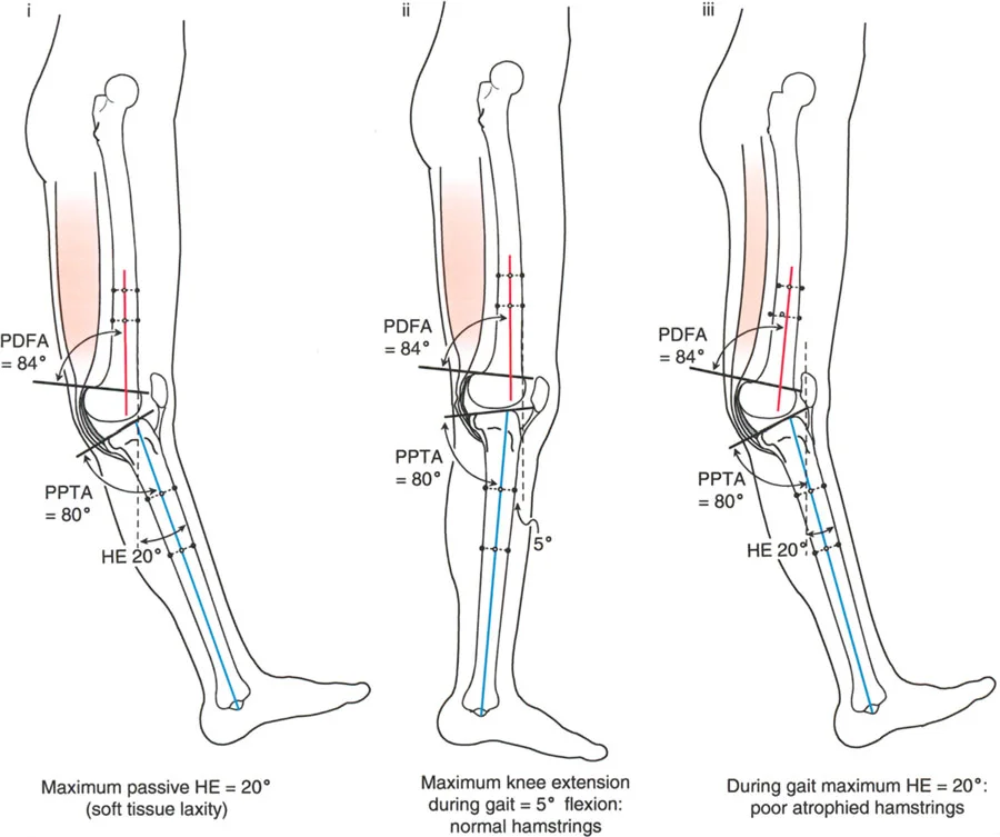 صورة طبية: جراحة إعادة تنظيم الركبة: حل متقدم لخشونة المفصل أحادي الحجرة وتشوهات الركبة
