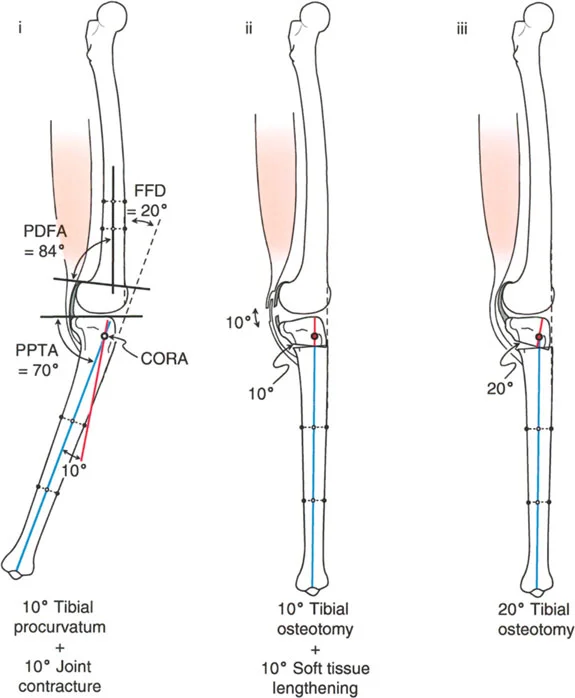 صورة طبية: جراحة إعادة تنظيم الركبة: حل متقدم لخشونة المفصل أحادي الحجرة وتشوهات الركبة