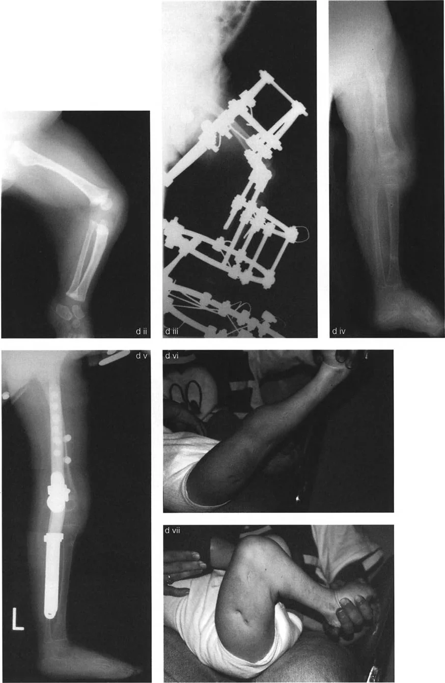 صورة طبية: جراحة إعادة تنظيم الركبة: حل متقدم لخشونة المفصل أحادي الحجرة وتشوهات الركبة
