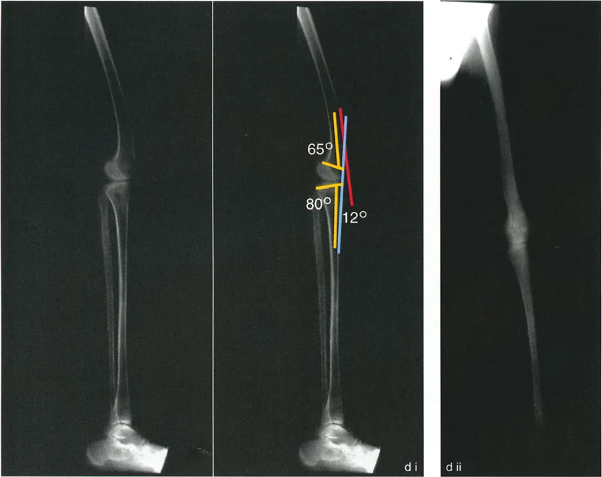 صورة توضيحية لـ جراحة إعادة تنظيم الركبة: حل متقدم لخشونة المفصل أحادي الحجرة وتشوهات الركبة