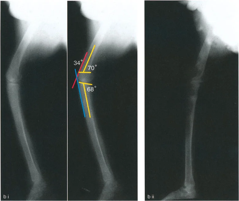 صورة طبية: جراحة إعادة تنظيم الركبة: حل متقدم لخشونة المفصل أحادي الحجرة وتشوهات الركبة