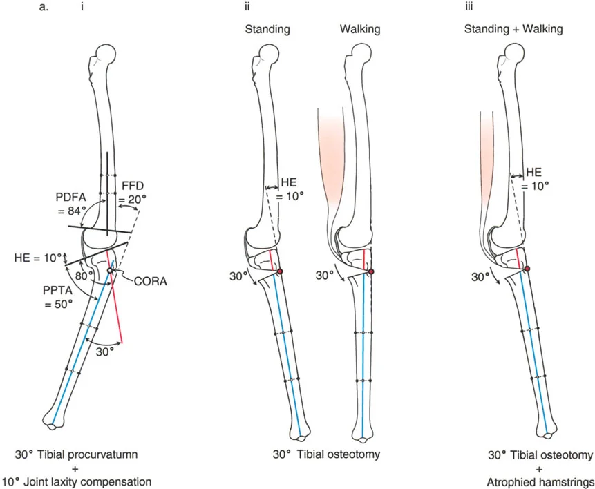 صورة طبية: جراحة إعادة تنظيم الركبة: حل متقدم لخشونة المفصل أحادي الحجرة وتشوهات الركبة