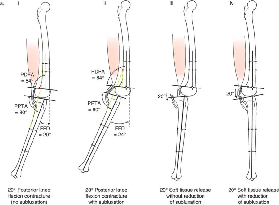 صورة طبية: جراحة إعادة تنظيم الركبة: حل متقدم لخشونة المفصل أحادي الحجرة وتشوهات الركبة