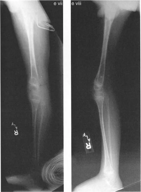 صورة طبية: جراحة إعادة تنظيم الركبة: حل متقدم لخشونة المفصل أحادي الحجرة وتشوهات الركبة