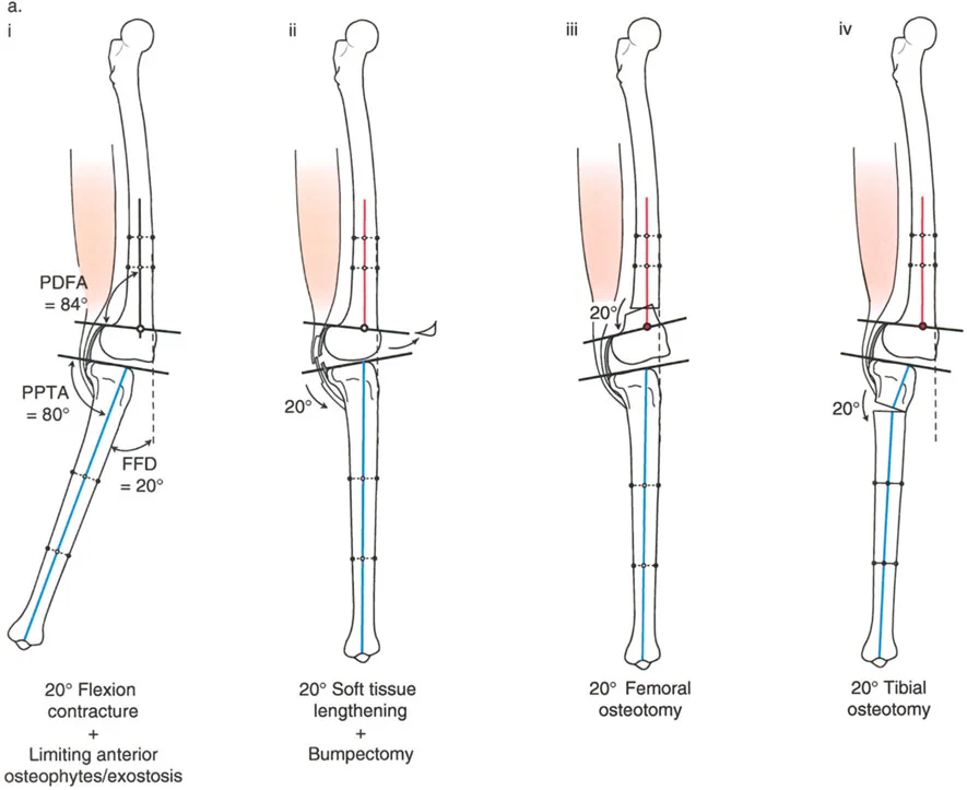 صورة طبية: جراحة إعادة تنظيم الركبة: حل متقدم لخشونة المفصل أحادي الحجرة وتشوهات الركبة