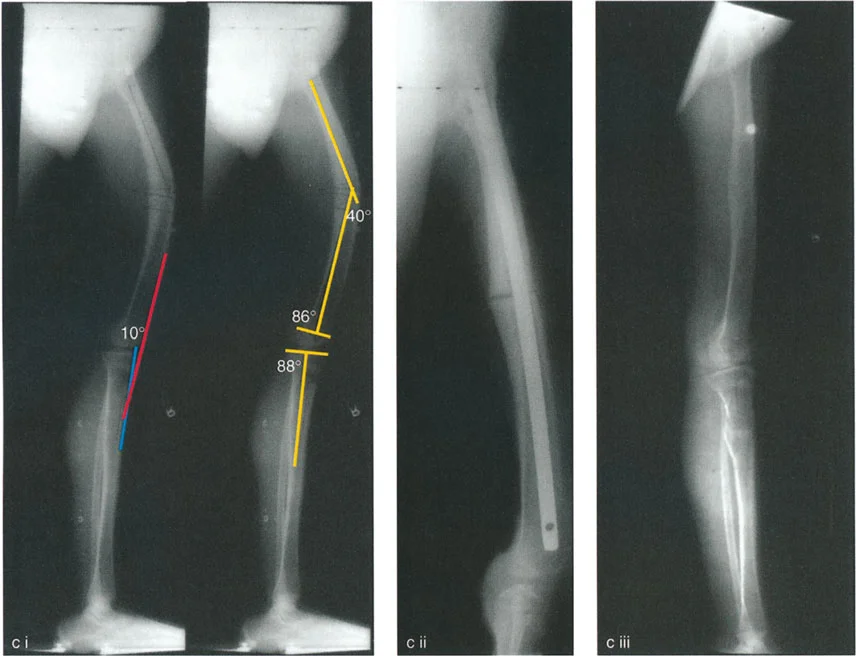 صورة توضيحية لـ الركبة الارتدادية (فرط تمدد الركبة): دليل شامل للعلاج مع الأستاذ الدكتور محمد هطيف
