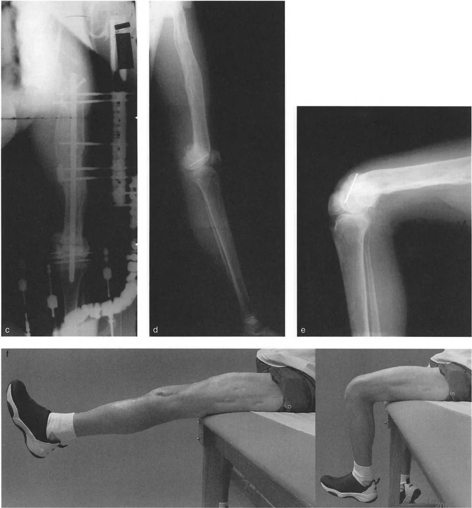 توضيح لعملية قطع العظم فوق الحدبة الظنبوبية لتصحيح التقوس الخلفي