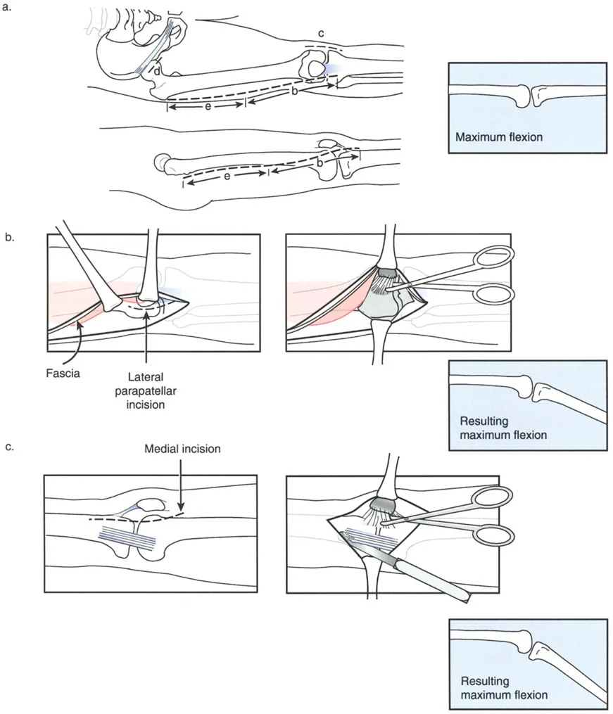 تصحيح التقوس الخلفي الناتج عن العلاج الإشعاعي باستخدام الإطار الدائري