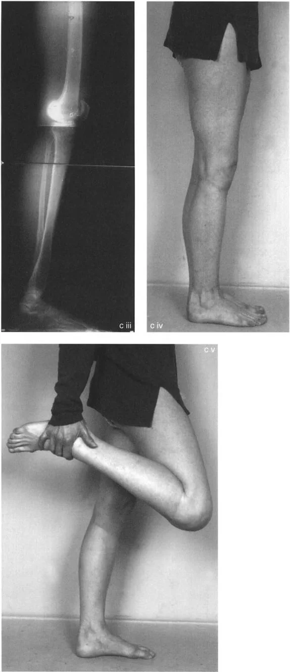 توضيح لتقوس الفخذ الأمامي وتأثيره على محاذاة الركبة