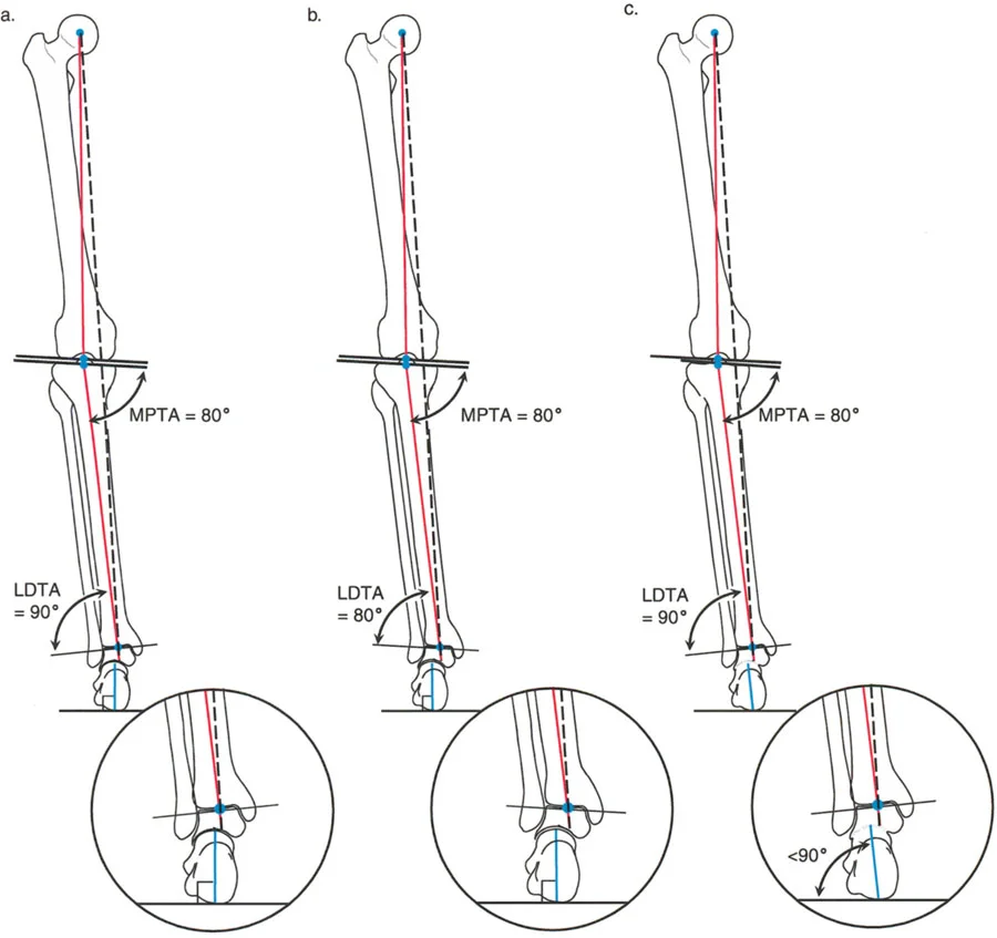 صورة طبية: الاستاذ الدكتور محمد هطيف: دليل شامل لتشوهات قصبة الساق البعيدة والكاحل في صنعاء