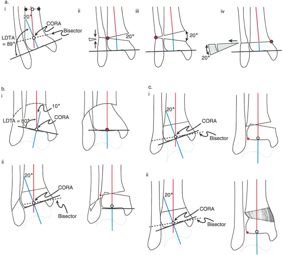 صورة طبية: الاستاذ الدكتور محمد هطيف: دليل شامل لتشوهات قصبة الساق البعيدة والكاحل في صنعاء
