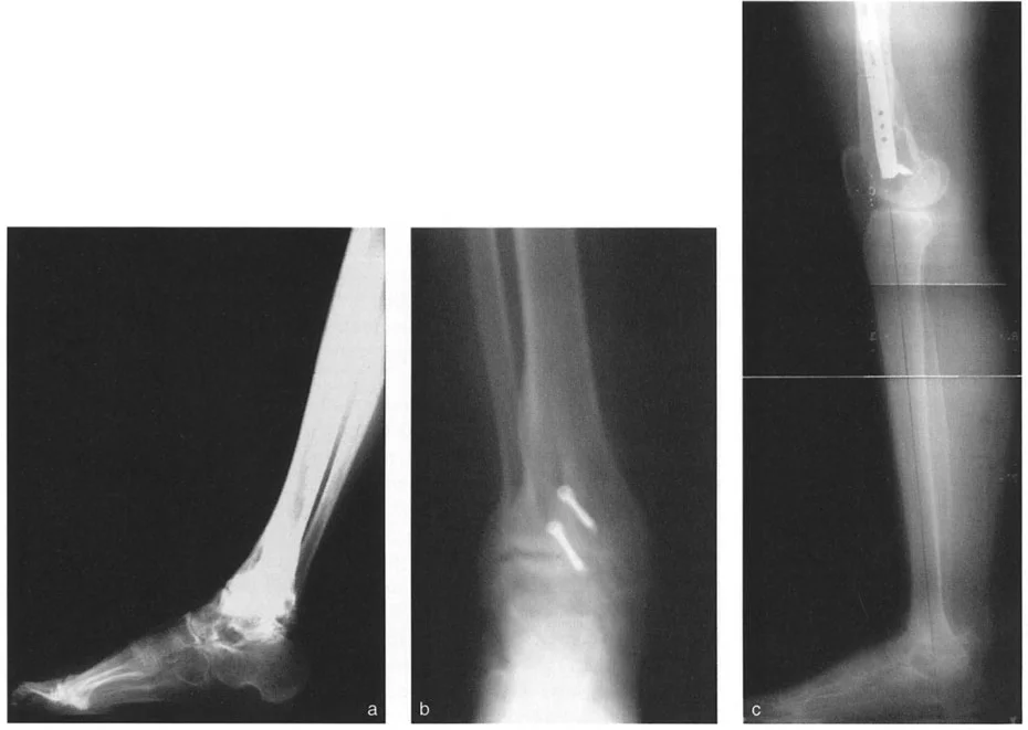 صورة طبية: الاستاذ الدكتور محمد هطيف: دليل شامل لتشوهات قصبة الساق البعيدة والكاحل في صنعاء