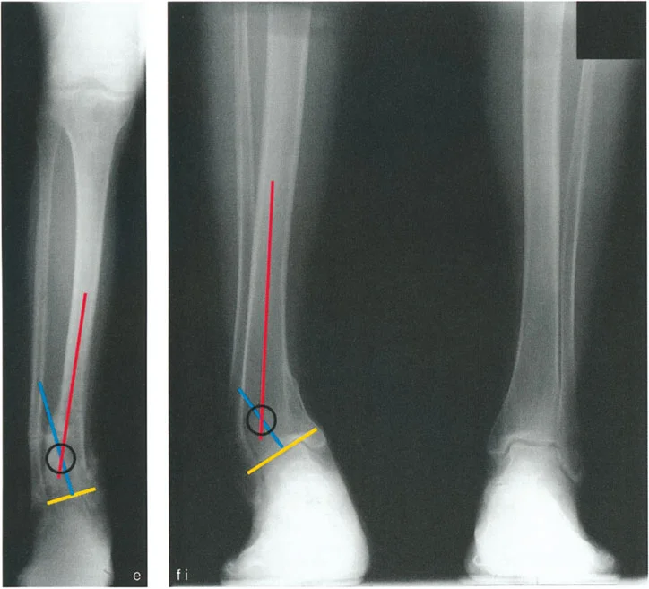 صورة طبية: الاستاذ الدكتور محمد هطيف: دليل شامل لتشوهات قصبة الساق البعيدة والكاحل في صنعاء
