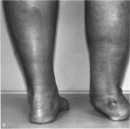 صورة طبية: الاستاذ الدكتور محمد هطيف: دليل شامل لتشوهات قصبة الساق البعيدة والكاحل في صنعاء