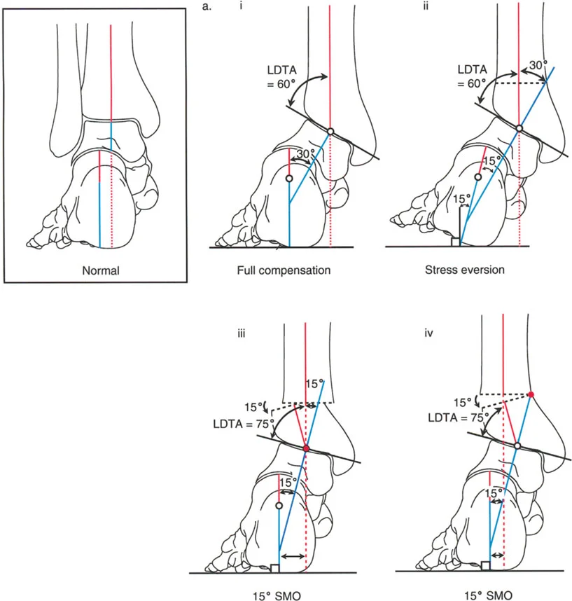صورة طبية: الاستاذ الدكتور محمد هطيف: دليل شامل لتشوهات قصبة الساق البعيدة والكاحل في صنعاء