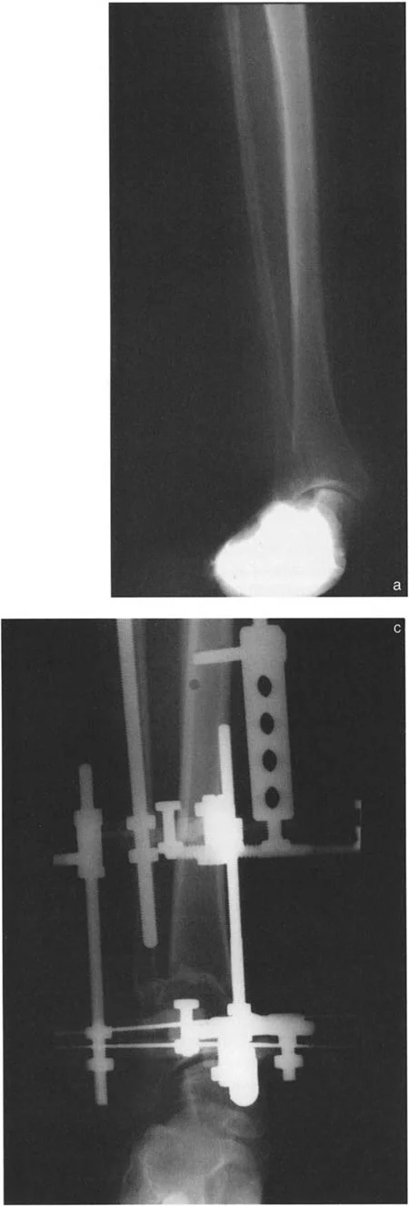 صورة طبية: الاستاذ الدكتور محمد هطيف: دليل شامل لتشوهات قصبة الساق البعيدة والكاحل في صنعاء