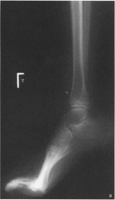 صورة طبية: الاستاذ الدكتور محمد هطيف: دليل شامل لتشوهات قصبة الساق البعيدة والكاحل في صنعاء