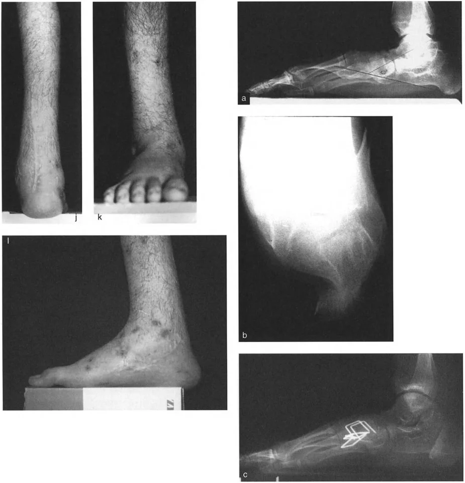 صورة طبية: الاستاذ الدكتور محمد هطيف: دليل شامل لتشوهات قصبة الساق البعيدة والكاحل في صنعاء