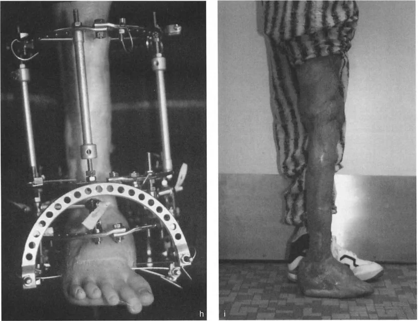 صورة طبية: الاستاذ الدكتور محمد هطيف: دليل شامل لتشوهات قصبة الساق البعيدة والكاحل في صنعاء