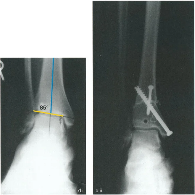 صورة طبية: الاستاذ الدكتور محمد هطيف: دليل شامل لتشوهات قصبة الساق البعيدة والكاحل في صنعاء